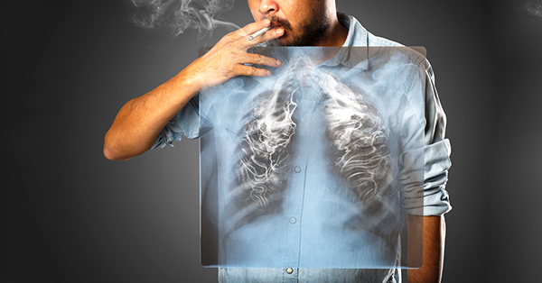 Smoking-related Lung Diseases